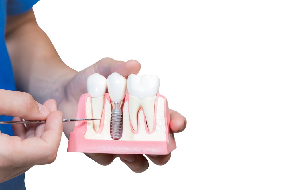 implant dentar craiova, clinica stomatologica craiova, clinica stomatologica dr katta