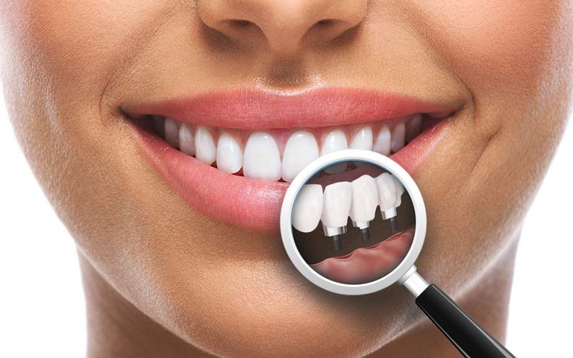 implant dentar craiova, implantologie craiova, dr. katta, clinica stomatologica craiova
