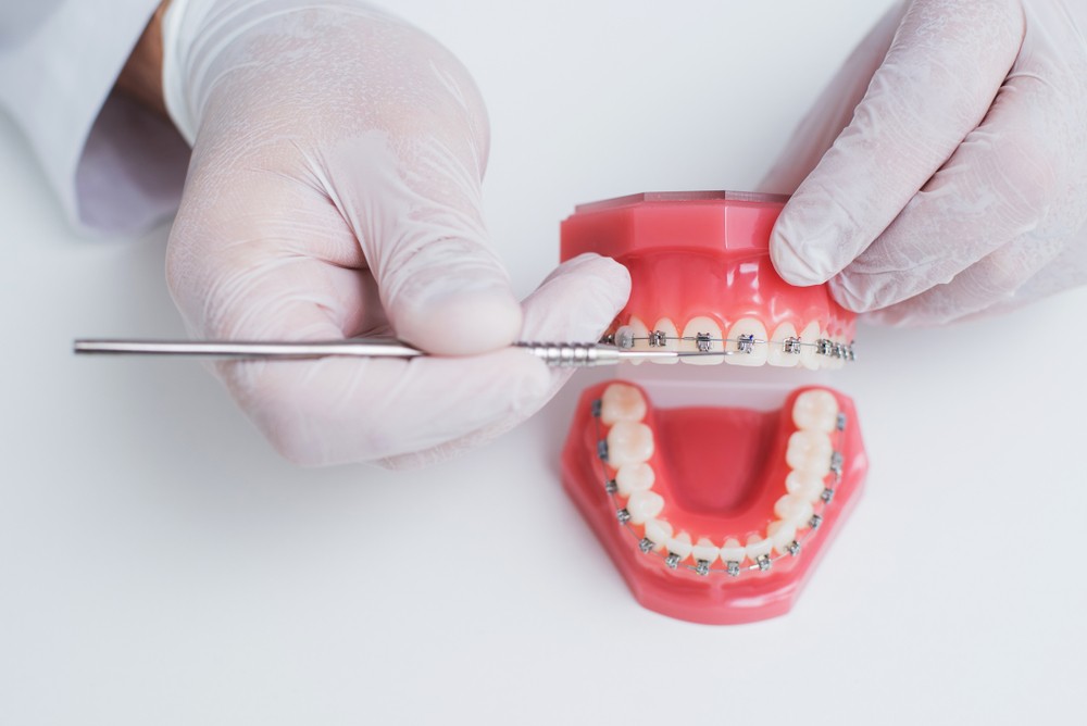 aparat dentar craiova, ortodontie craiova, clinica stomatologica dr. katta craiova