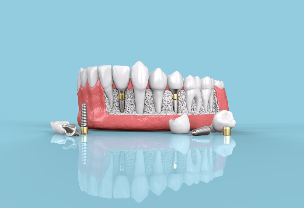 implant dentar craiova, clinica stomatologica craiova, clinica stomatologica dr katta
