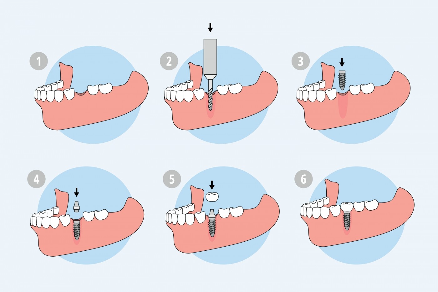 implant dentar