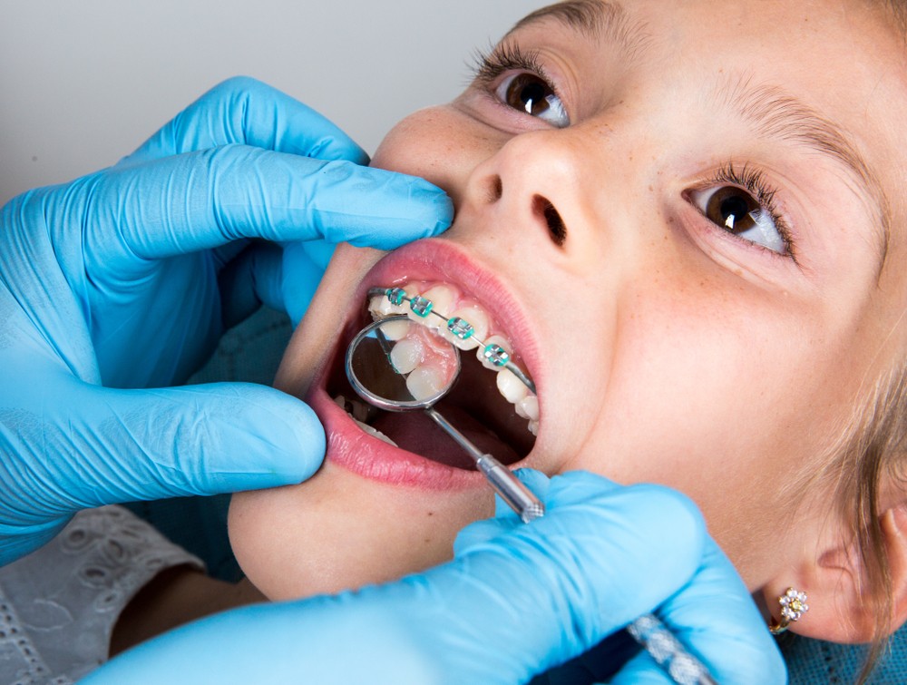 aparat dentar craiova, ortodontie craiova, clinica stomatologica dr. katta craiova