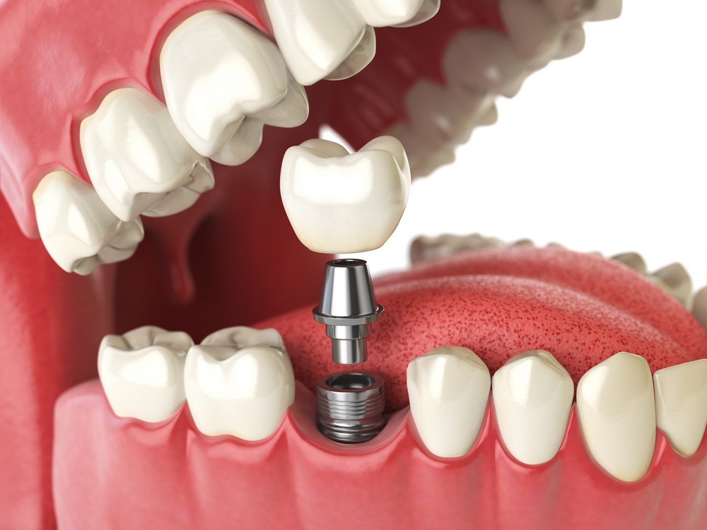 implant dentar craiova, clinica stomatologica craiova, clinica stomatologica dr katta