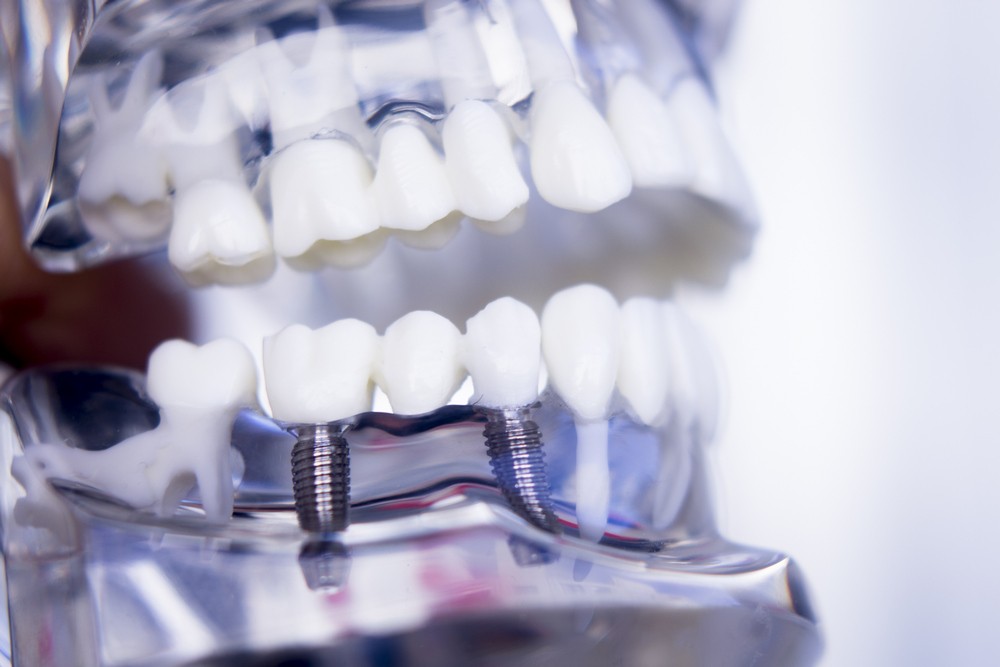 implant dentar craiova, implant dentar craiova pret, implantologie craiova pret, katta dental care